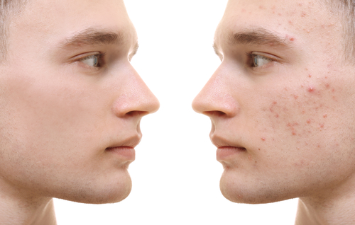 Young man before and after acne treatment on white background