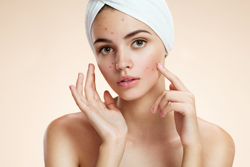 Scowling girl pointing at her acne with a towel on her head