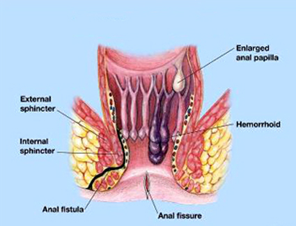 anorectal disorders