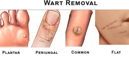 wart removal illustration